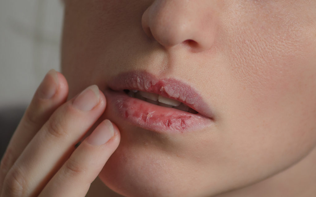 6 verrassende oorzaken van droge lippen
