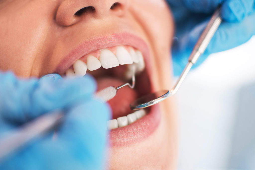 “Onze orthodontist raadde ons een extra verzekering aan”