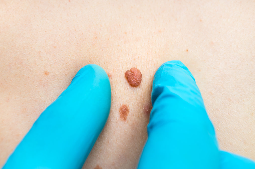 Zwakke plek van melanomen ontdekt: hoop op nieuwe behandelingen