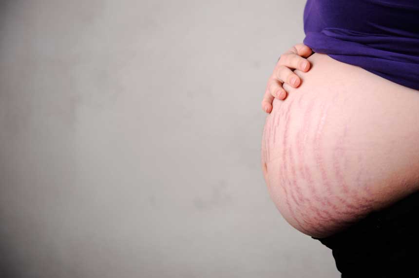 Zwangerschapsstriemen Laten Verwijderen – De Beste Tips